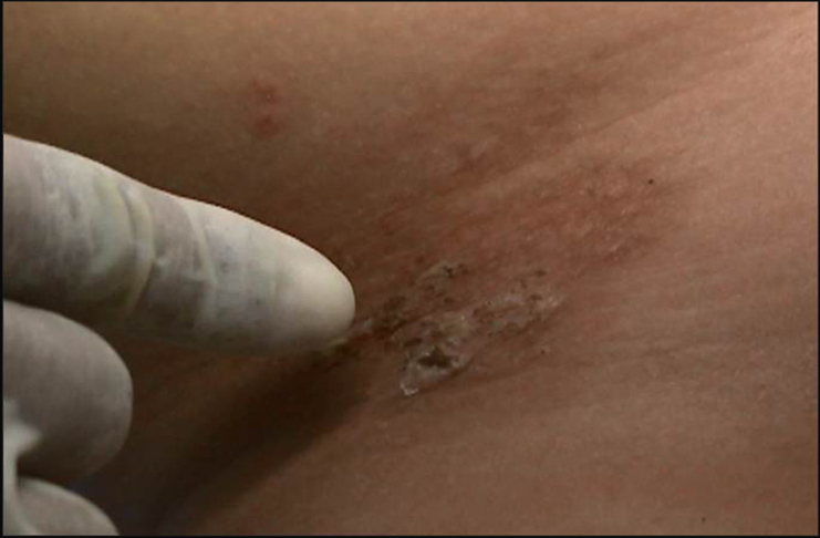 La Vulcanodinium rugosum provoca un tipo de lesiones dermatológicas que difiere por completo de la ocasionada por caribes. En este caso, además de ardor en la piel y enrojecimiento, pueden llegar a purulentas.