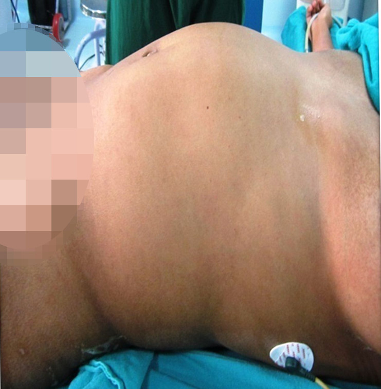 Mostrando abultamiento abdominal con margen mal definido. /Foto: BMJ Case Reports.