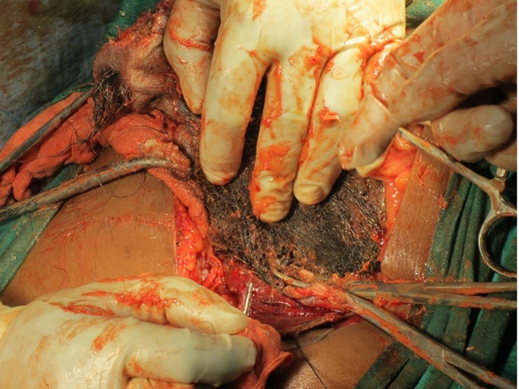 Mostrando una masa encapsulada que se extiende desde la superficie inferior del hígado hasta el riñón pélvico. /Foto: BMJ Case Reports.