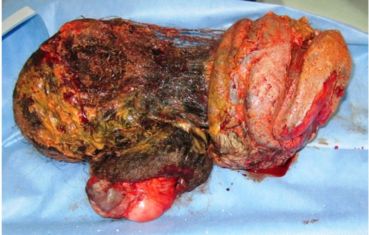 La muestra consta de pelos, huesos maduros y otras partes del cuerpo. /Foto: BMJ Case Reports.