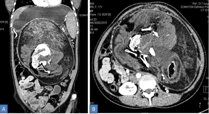 Tomografía computarizada abdominal con contraste que muestra una masa de 25×23×15 cm con múltiples densidades calcificadas que comprimen las vísceras abdominales adyacentes. /Foto: BMJ Case Reports.