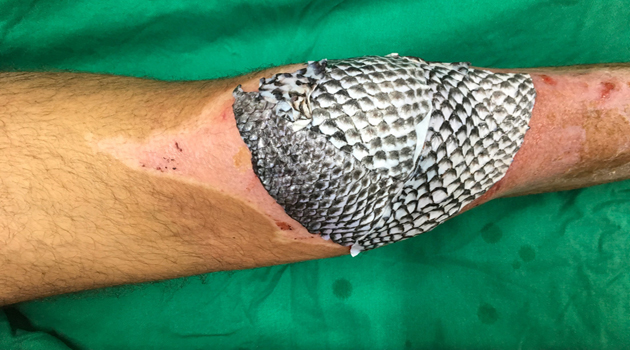 Paciente brasileño tratado con piel de tilapia. /Foto: Cortesía de Edmar Maciel