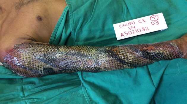 Paciente brasileño tratado con piel de tilapia. /Foto: Cortesía de Edmar Maciel