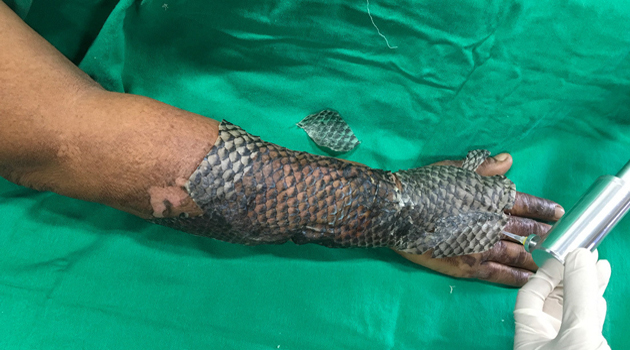 Paciente brasileño tratado con piel de tilapia. /Foto: Cortesía de Edmar Maciel