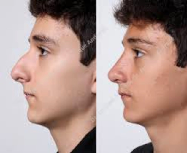 Rinoplastia, cirugía de nariz. /Foto: Tomada de Internet
