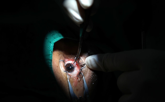 Colocar el lente intraocular requiere de alta precisión. / Foto: Juan Carlos Dorado Fernández / 5 de Septiembre